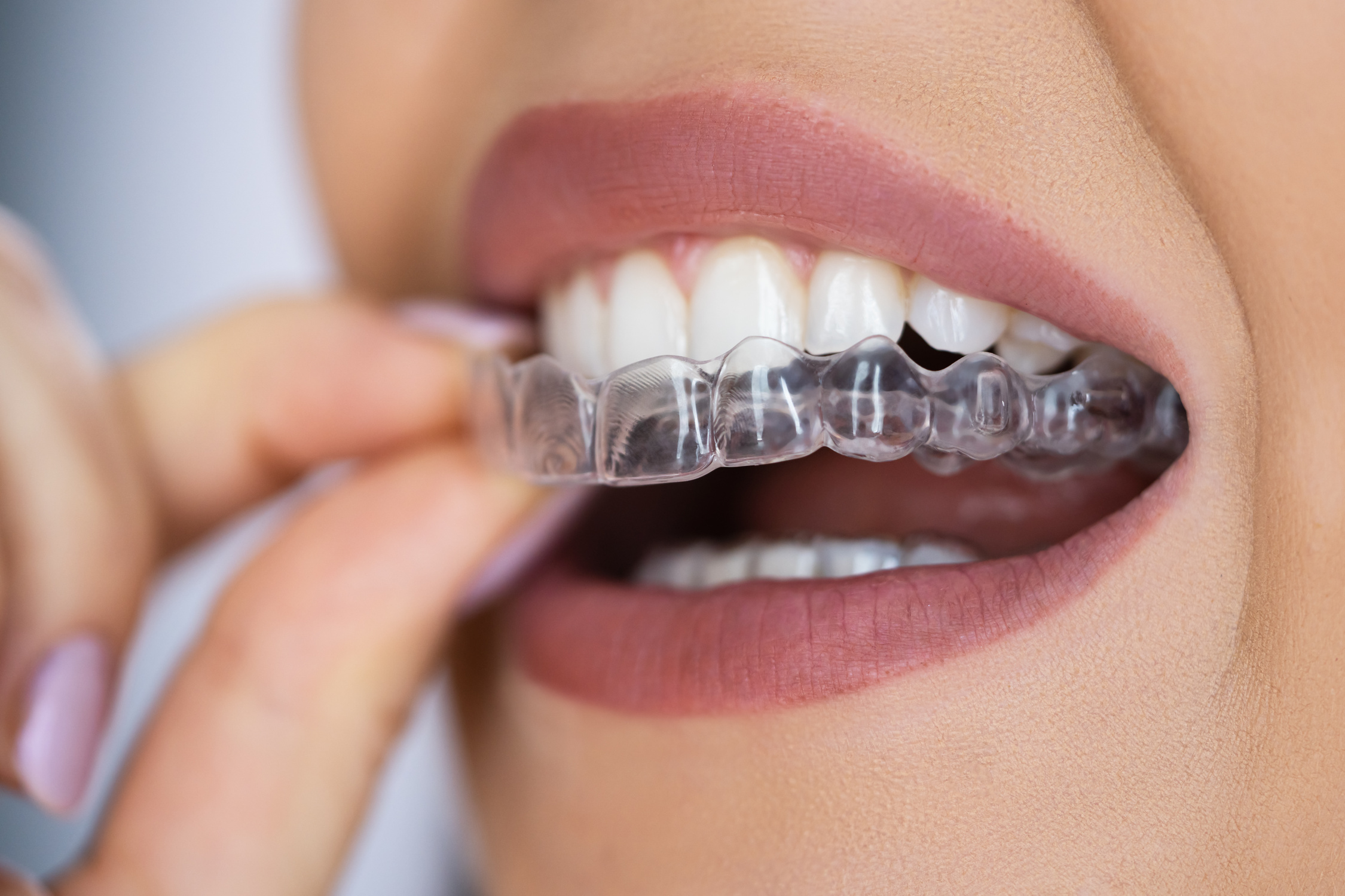 What Are Clear Aligners and How Do They Work? A Complete Guide to Invisible Braces